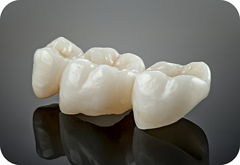 Close up of metal free dental bridge