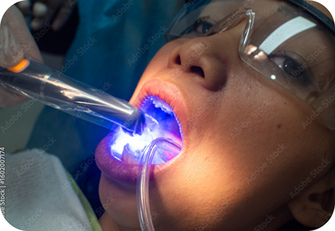 Close up of cosmetic bonding treatment