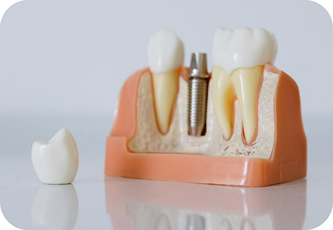 Model of dental implant with crown sitting nearby