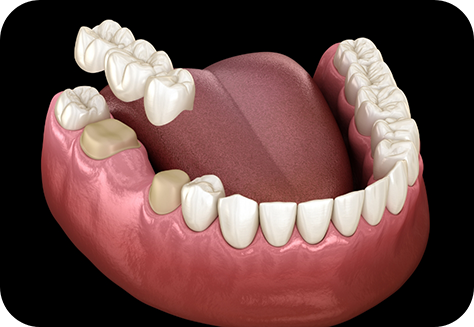 Illustration of dental bridged being attached to teeth in lower arch