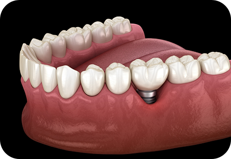 Illustration of dental implant in lower jaw