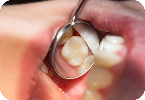 Using dental mirror to examine teeth