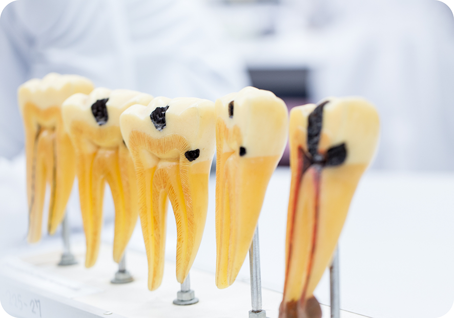 Models of infected teeth sitting in row