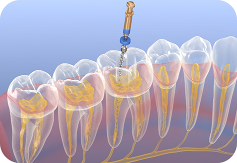 Illustration of root canal treatment performed on teeth in lower arch