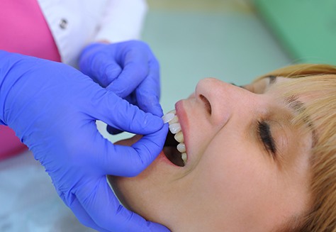 Dentist in El Cajon placing veneers on a patient's teeth 
