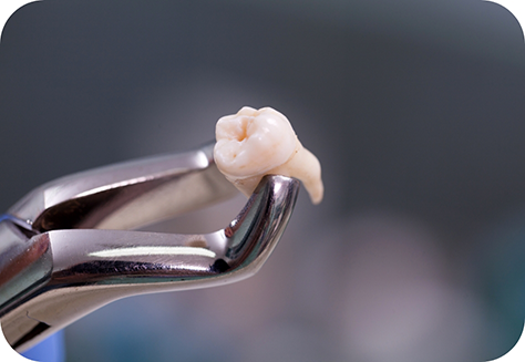 Wisdom tooth held with forceps